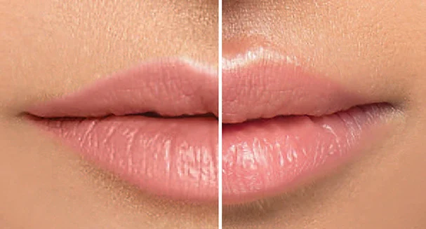 resultats-repulpeur-levres-lipojen